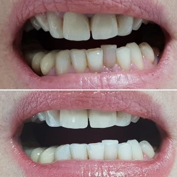 SDI Pola Proffesional Endodontik Devital Beyazlatma Ajanı