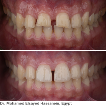 Dentsply Cerec Tessera Lityum Disilikat Cad-Cam C14 Blok 4'lü Kutu