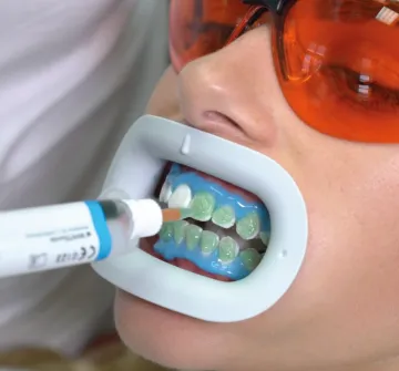 Fläsh Beyazlatma Cihazı - White Smile Beyazlatma Cihazı + 5 Tane İki Hastalık Kit Hediye!