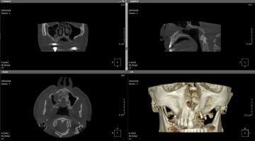 HDX WILL Eco-X Dental Tomografi - CBCT