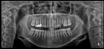 HDX WILL Eco-X Dental Tomografi - CBCT