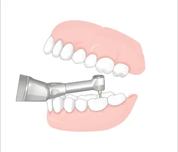 NSK ENDO-MATE TC2 Kablosuz Endodontik Mikromotor (Apex Locater Uyumlu)